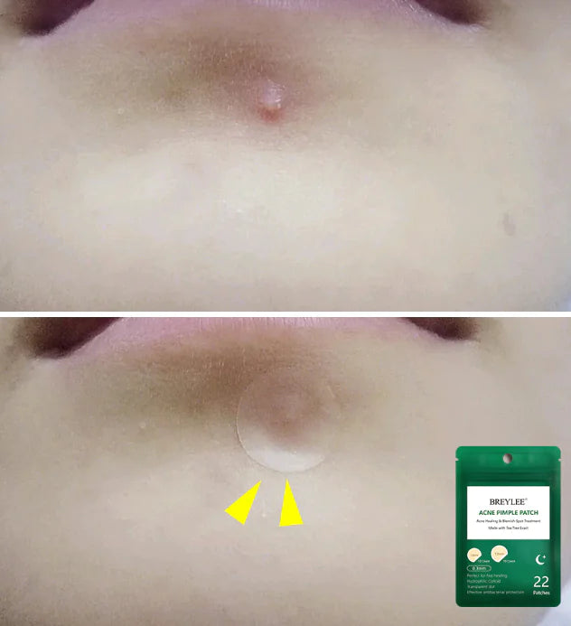 Night Acne Patches for Fading Acne Marks