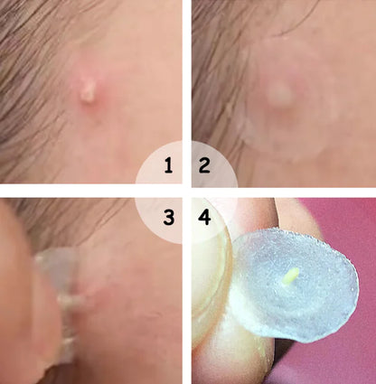 Night Acne Patches for Fading Acne Marks